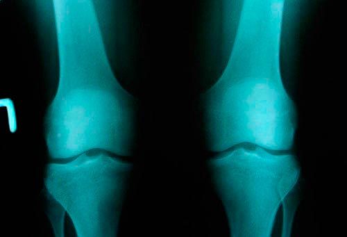 Инвалидность при артрозе и гонартрозе коленного сустава 2-3 степени